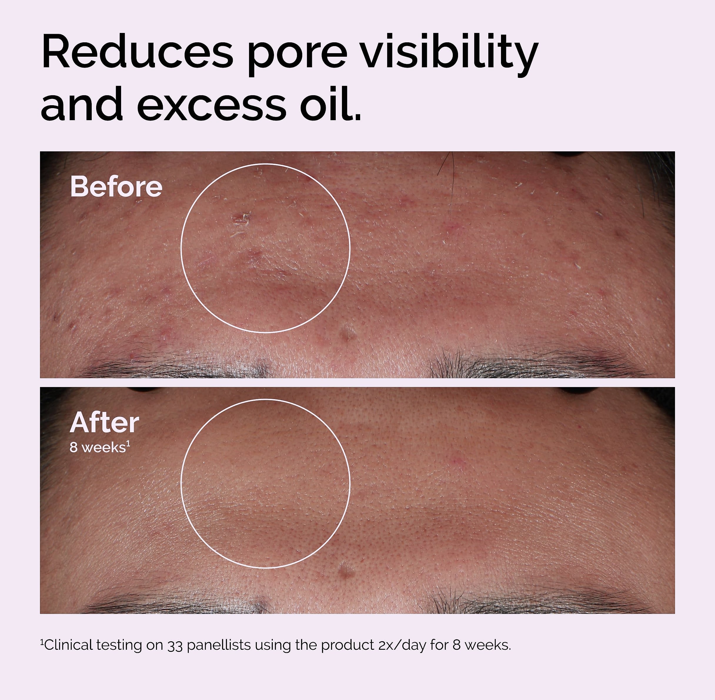 Niacinamide 10% + Zinc 1% Smoothing Serum for Blemish-Prone Skin