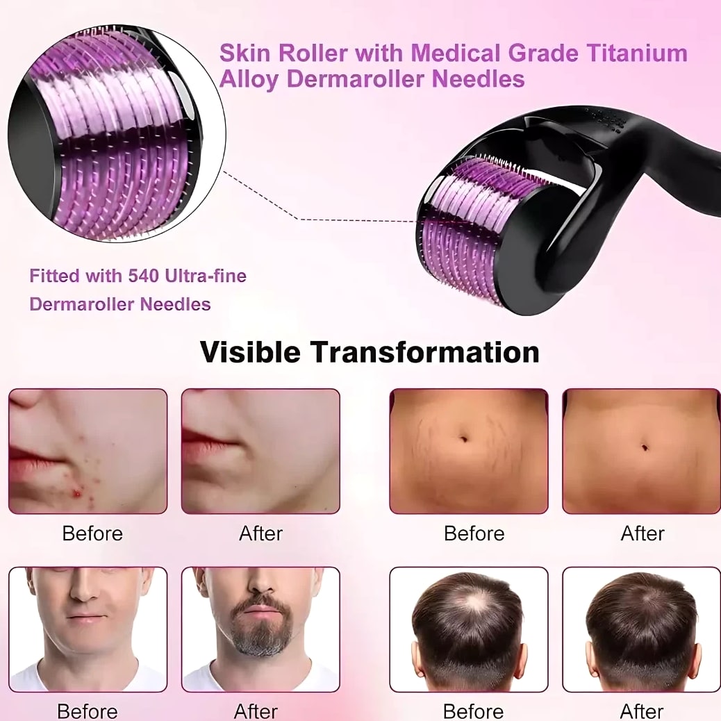 0.5mm 1mm 1.5mm 2.0mm 540 Microneedle Scar Derma Roller Dermaroller