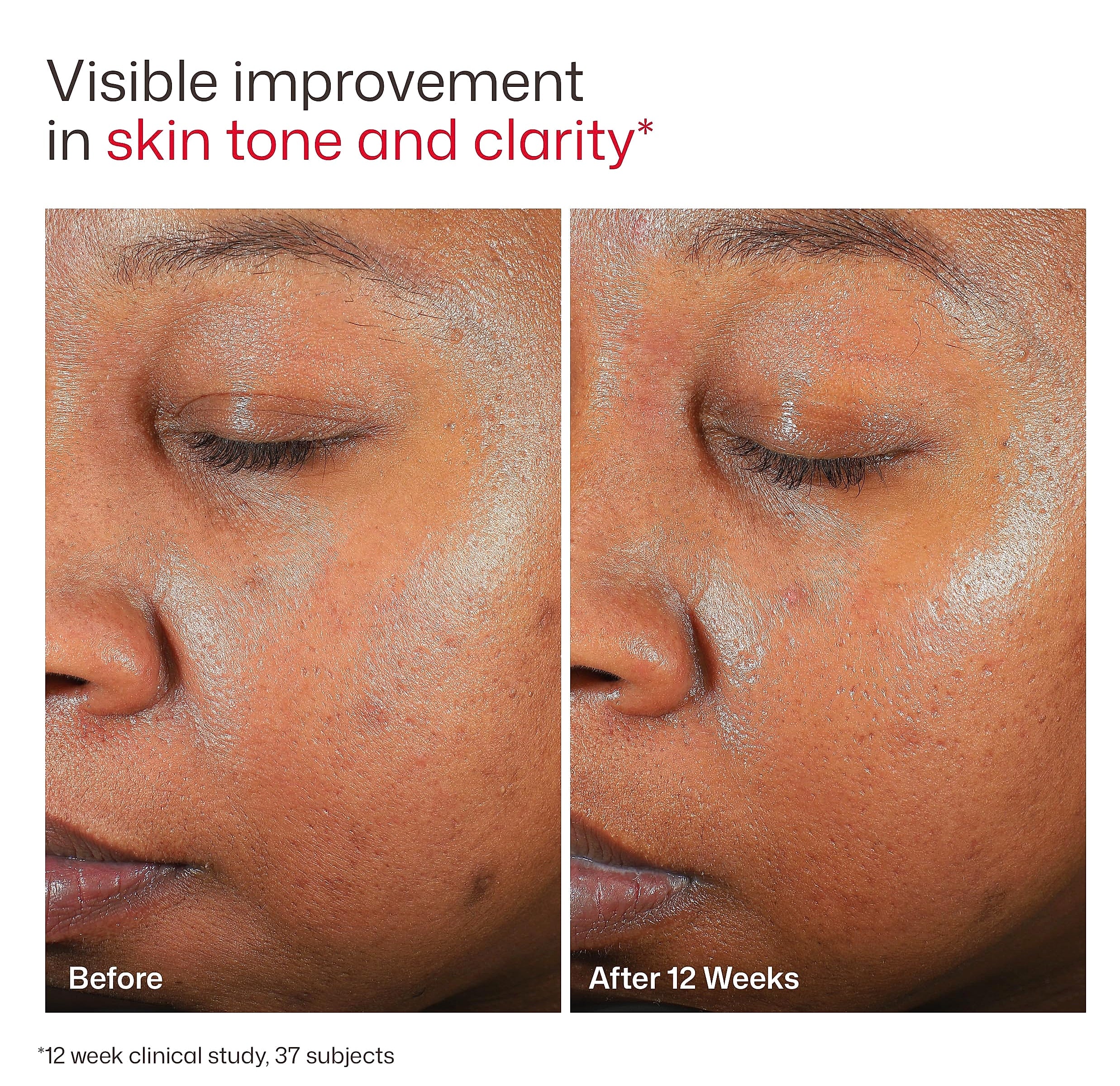 EltaMD UV Clear Face Sunscreen SPF 46 Oil-Free Sunscreen